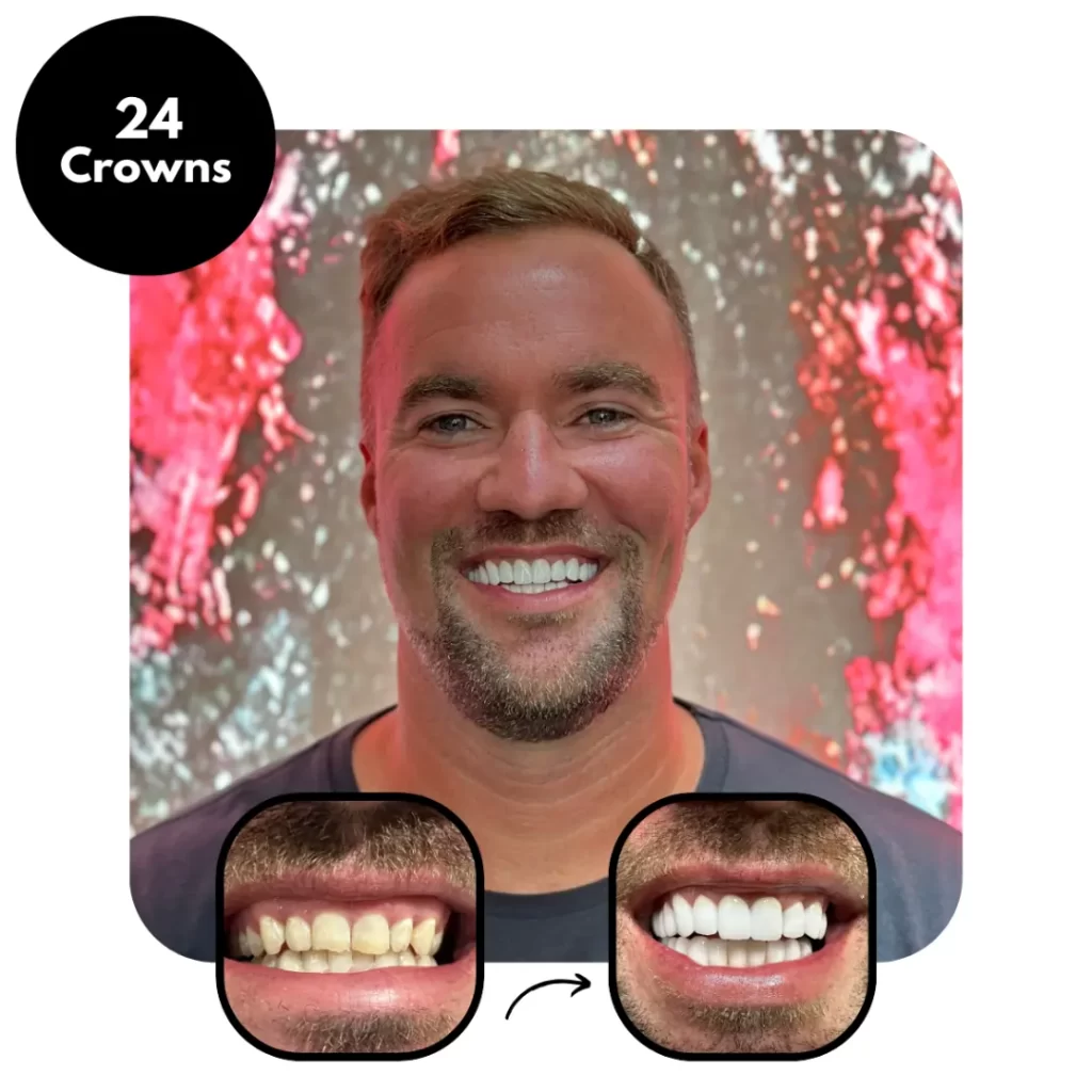 IdealofMeD 24 Dental Crowns Before & After