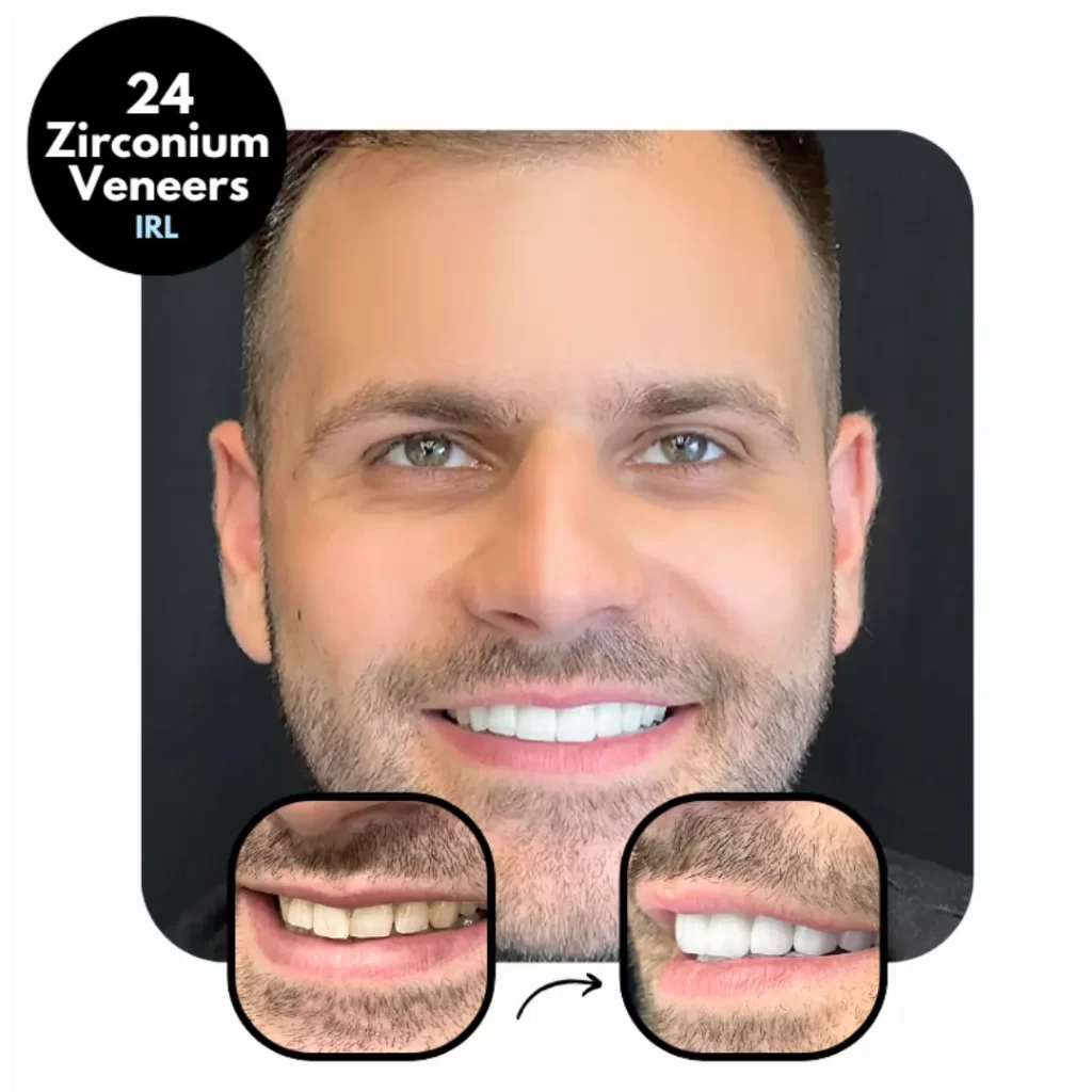 IdealofMeD Dental Veneers Before & After