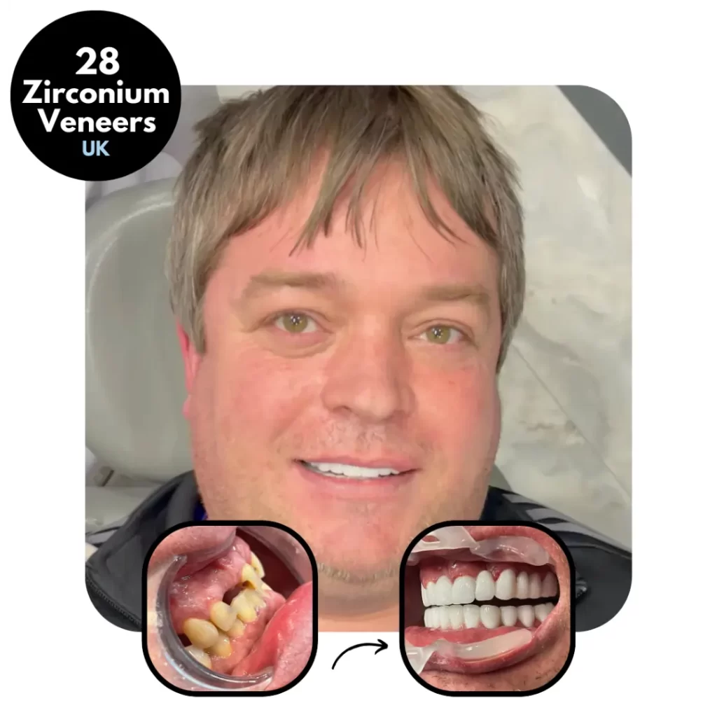 IdealofMeD 24 Dental Before & After Veneers