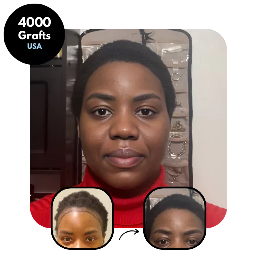 IdealofMeD Female-Afro-DHI-Hair-transplant-results-4000-grafts