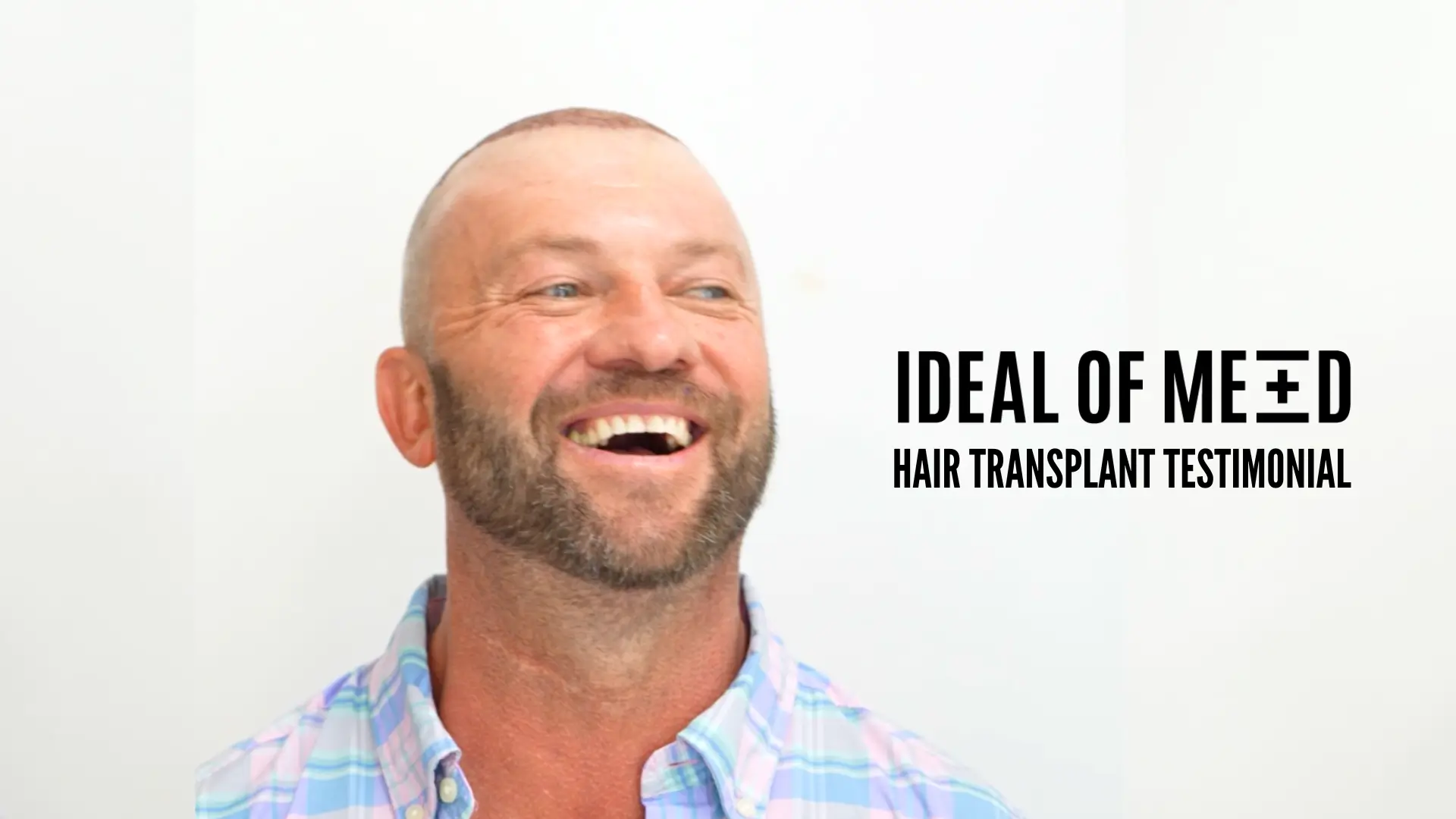 Jasons-hair-transplant-in-Turkey-at-IdealofMeD